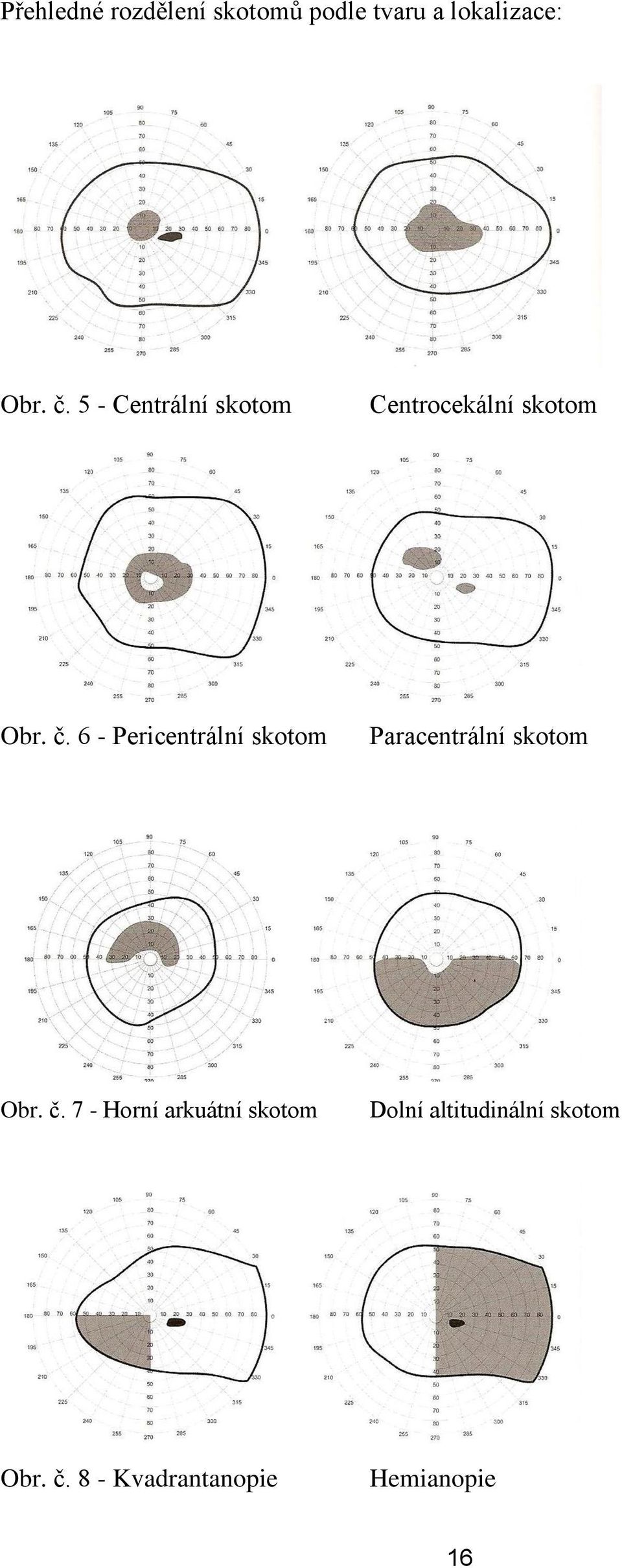 6 - Pericentrální skotom Paracentrální skotom Obr. č.