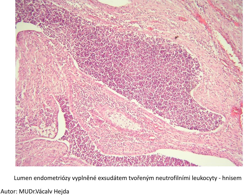 tvořeným neutrofilními