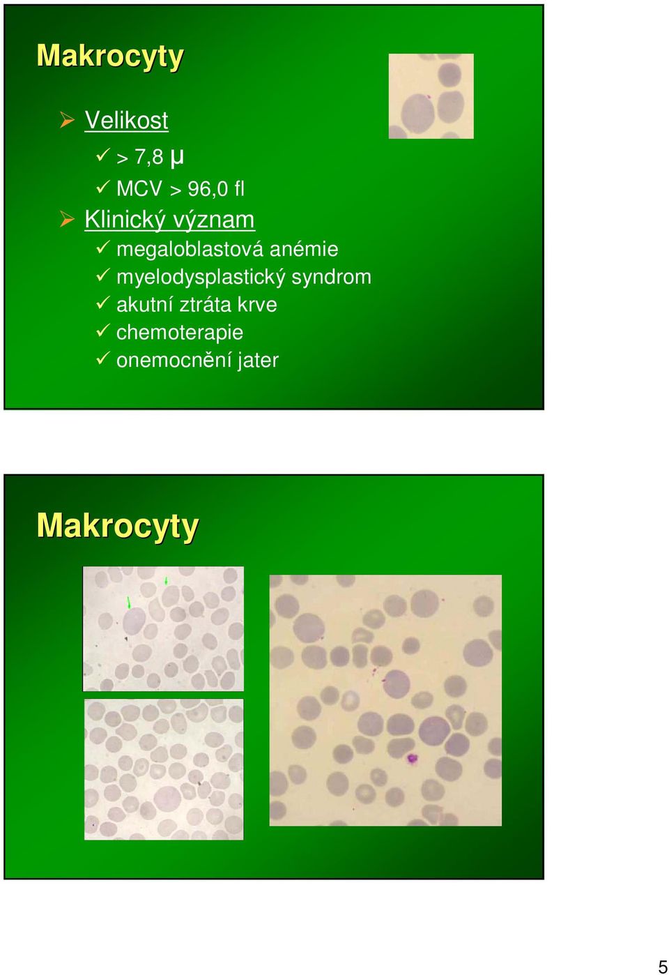 myelodysplastický syndrom akutní