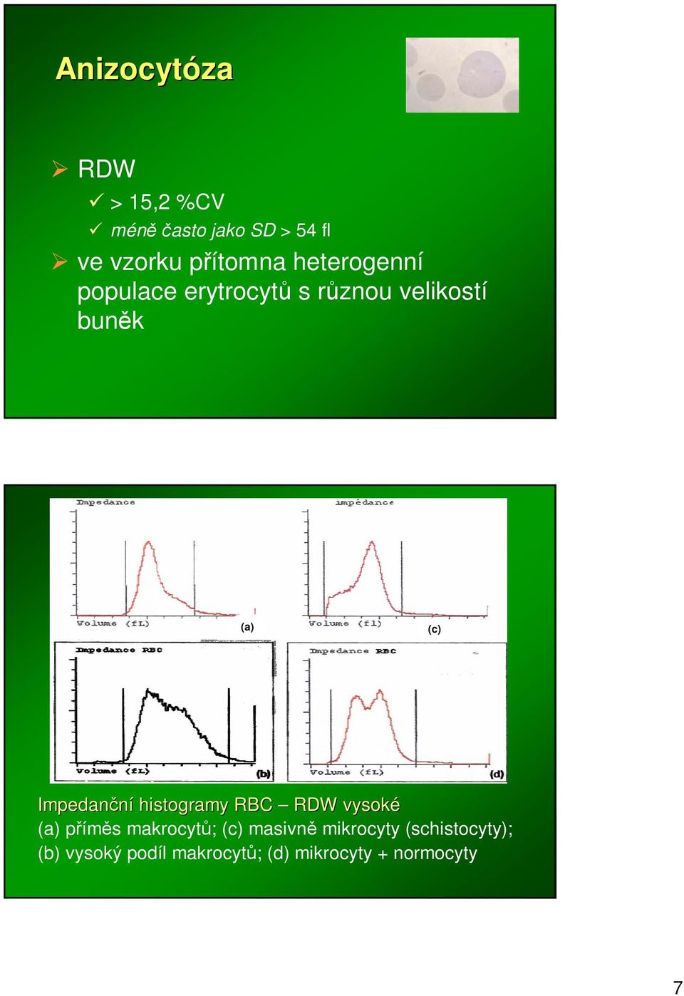 Impedanní histogramy RBC RDW vysoké (a) píms makrocyt; (c) masivn