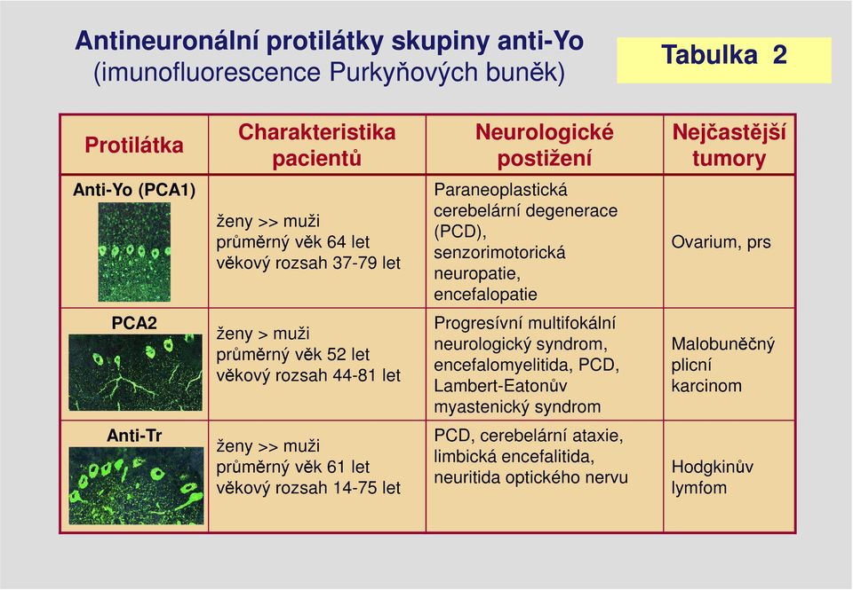 prs PCA2 ženy > muži průměrný věk 52 let věkový rozsah 44-81 let Progresívní multifokální neurologický syndrom, encefalomyelitida, PCD, Lambert-Eatonův myastenický syndrom