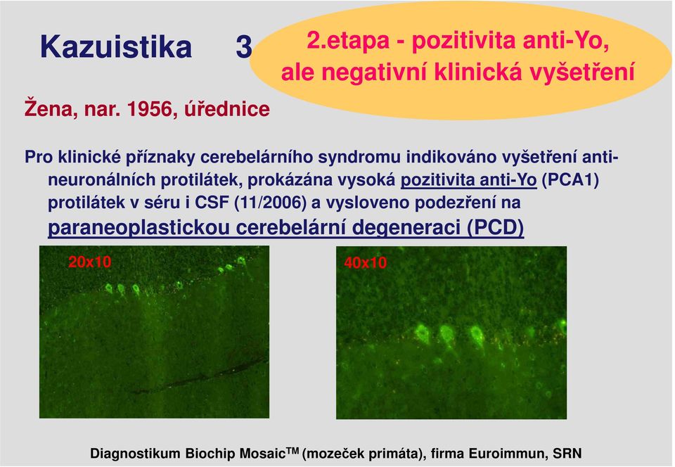 indikováno vyšetření antineuronálních protilátek, prokázána vysoká pozitivita anti-yo (PCA1) protilátek v
