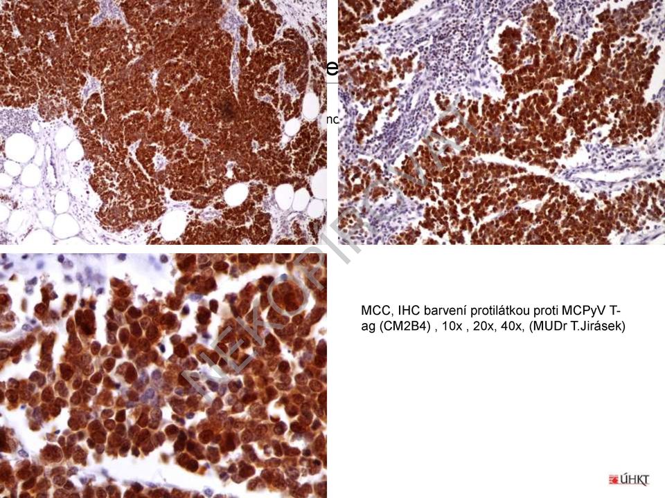 detekce MCC, IHC barvení protilátkou proti