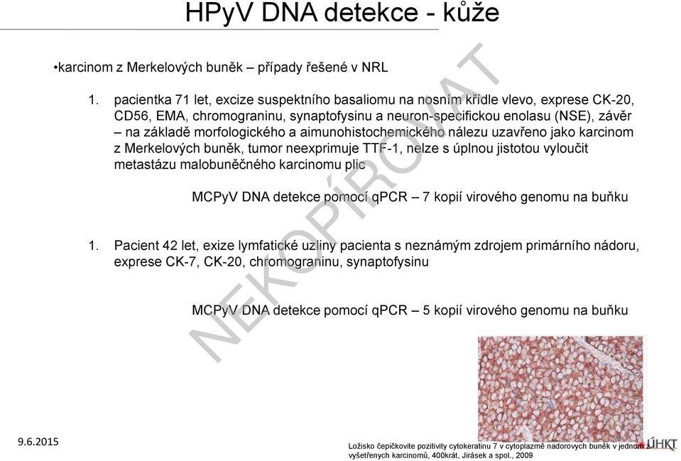 aimunohistochemického nálezu uzavřeno jako karcinom z Merkelových buněk, tumor neexprimuje TTF-1, nelze s úplnou jistotou vyloučit metastázu malobuněčného karcinomu plic MCPyV DNA detekce pomocí qpcr