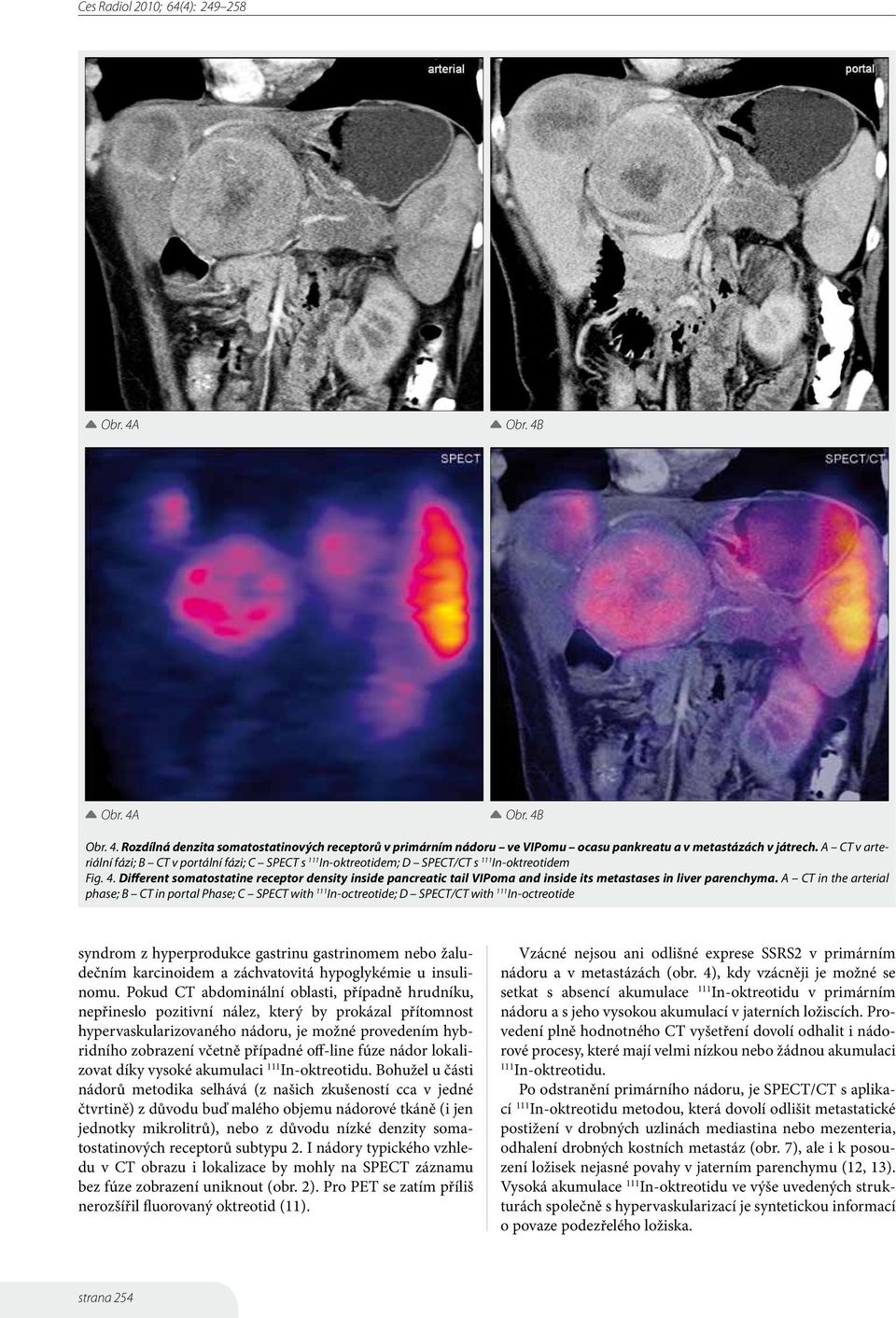 Different somatostatine receptor density inside pancreatic tail VIPoma and inside its metastases in liver parenchyma.