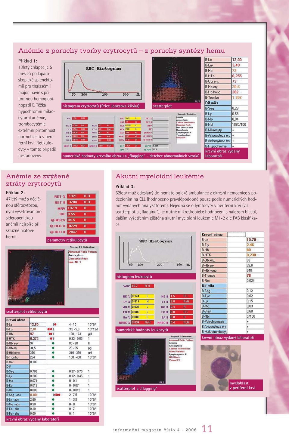 histogram erytrocytů (Price Jonesova křivka) scatterplot numerické hodnoty krevního obrazu a flagging detekce abnormálních vzorků krevní obraz vydaný laboratoří Anémie ze zvýšené ztráty erytrocytů