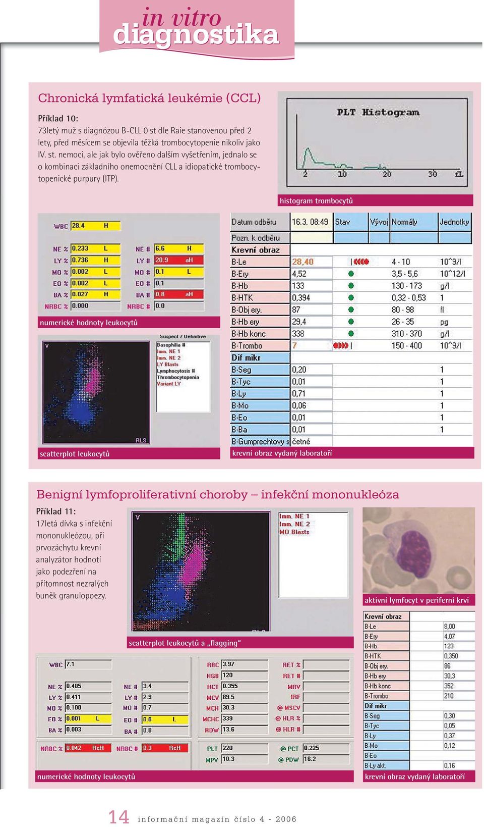 histogram trombocytů numerické hodnoty leukocytů scatterplot leukocytů krevní obraz vydaný laboratoří Benigní lymfoproliferativní choroby infekční mononukleóza Příklad 11: 17letá dívka s infekční