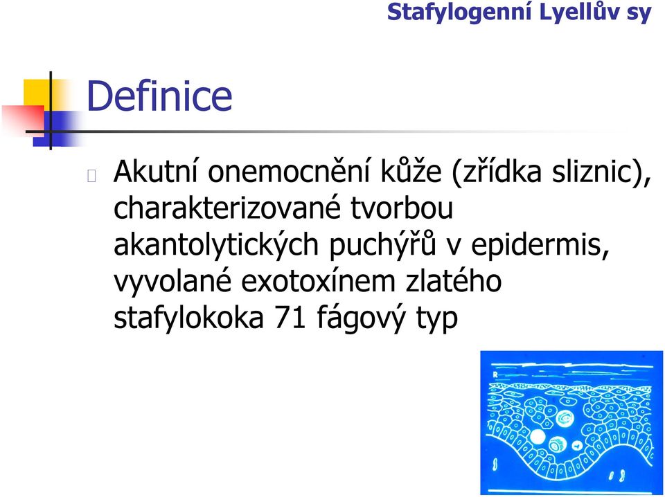 charakterizované tvorbou akantolytických