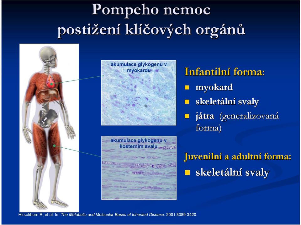 svaly játra (generalizovaná forma) Juvenilní a adultní forma: skeletáln lní svaly