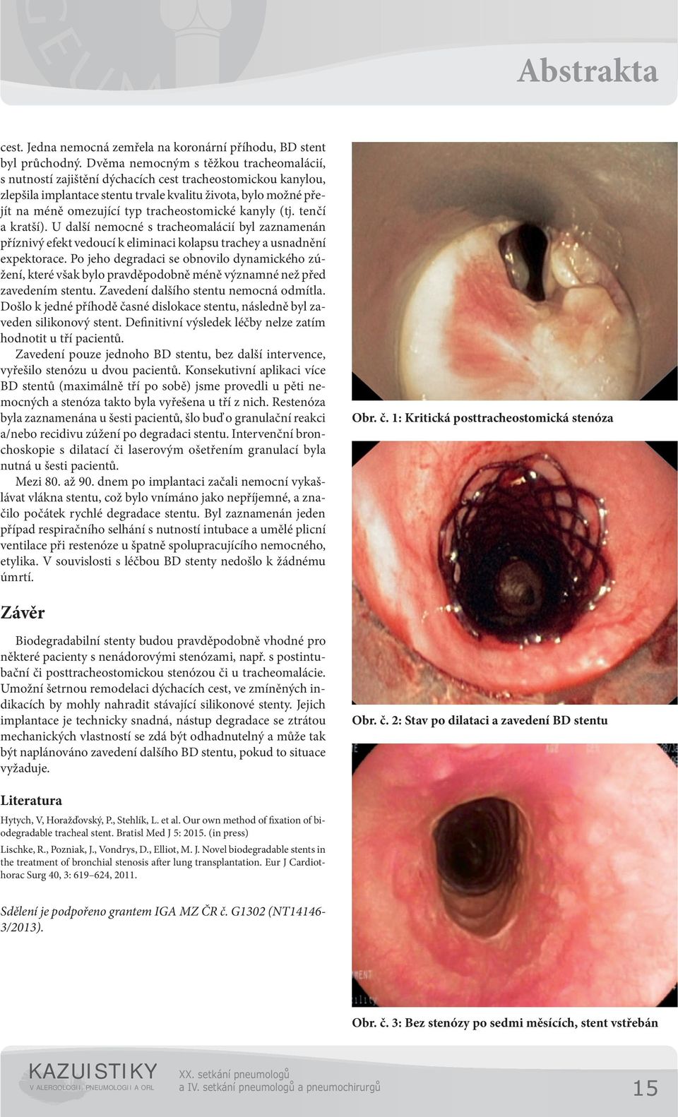 tracheostomické kanyly (tj. tenčí a kratší). U další nemocné s tracheomalácií byl zaznamenán příznivý efekt vedoucí k eliminaci kolapsu trachey a usnadnění expektorace.