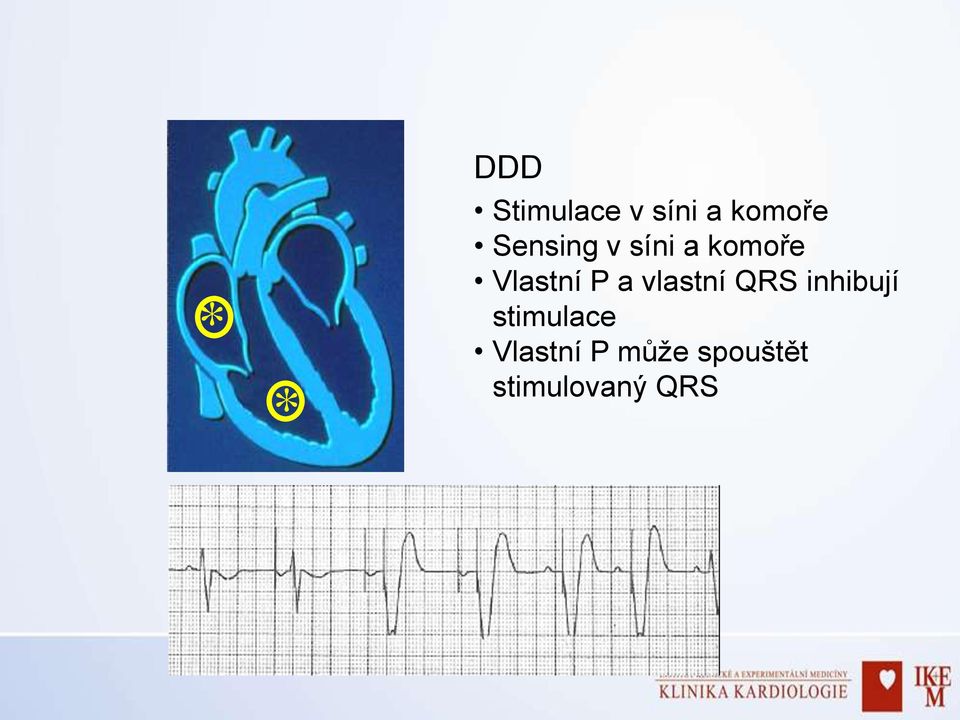 a vlastní QRS inhibují stimulace