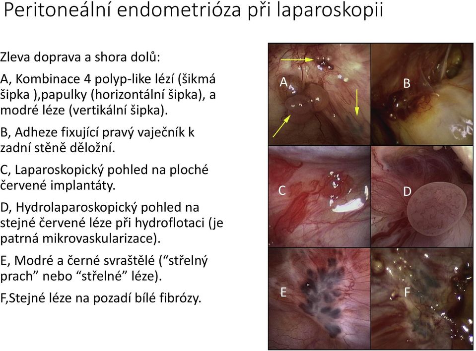 C, Laparoskopický pohled na ploché červené implantáty.