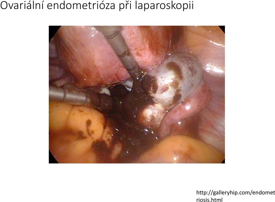 laparoskopii