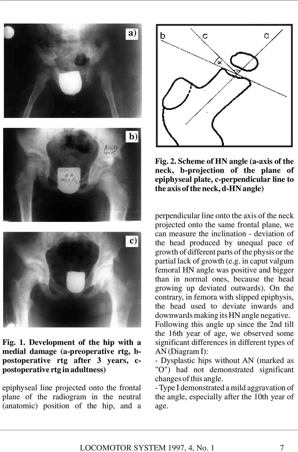 radiogram in the neutral (anatomic) position of the hip, and a perpendicular line onto the axis of the neck projected onto the same frontal plane, we can measure the inclination - deviation of the