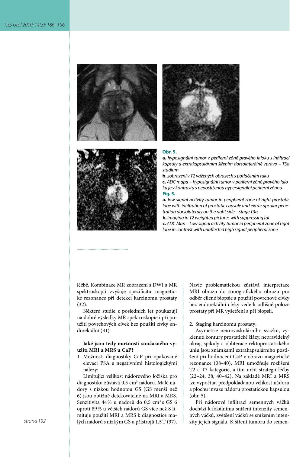 low signal activity tumor in peripheral zone of right prostatic lobe with infiltration of prostatic capsule and extracapsular penetration dorsolateraly on the right side stage T3a b.