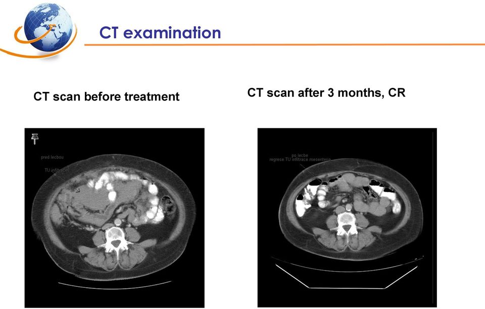 treatment CT