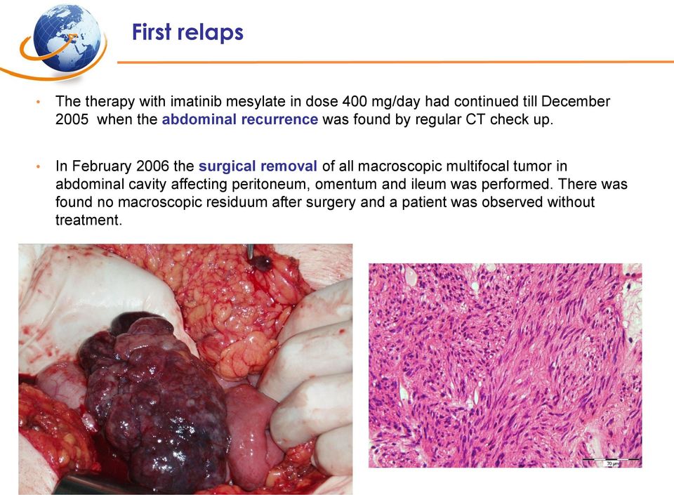In February 2006 the surgical removal of all macroscopic multifocal tumor in abdominal cavity