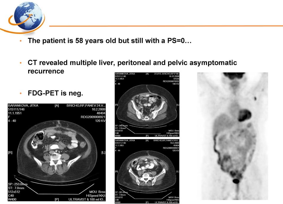 multiple liver, peritoneal and