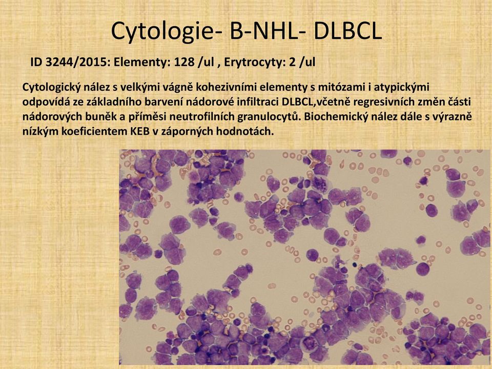nádorové infiltraci DLBCL,včetně regresivních změn části nádorových buněk a příměsi