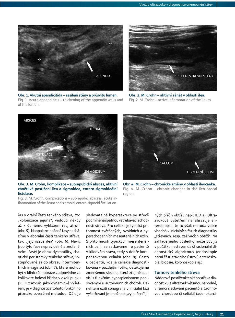 Fig. 3. M. Crohn, complications suprapubic abscess, acute inflammation of the ileum and sigmoid, entero-sigmoid fistulation. Obr. 4. M. Crohn chronické změny v oblasti ileocaeka. Fig. 4. M. Crohn chronic changes in the ileo-caecal region.