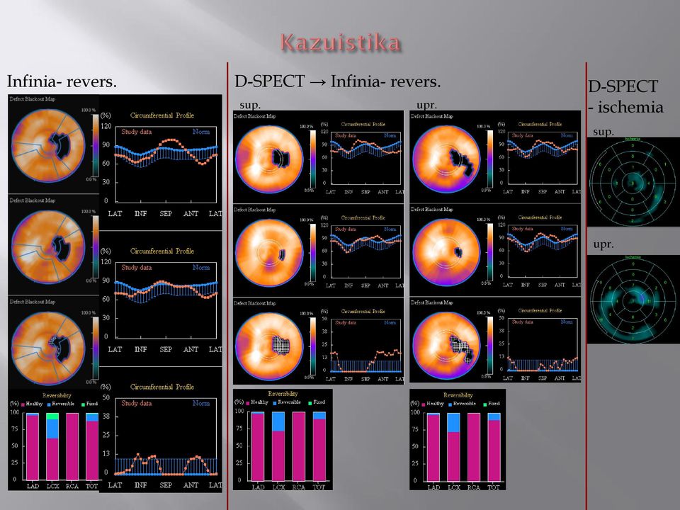 D-SPECT - ischemia