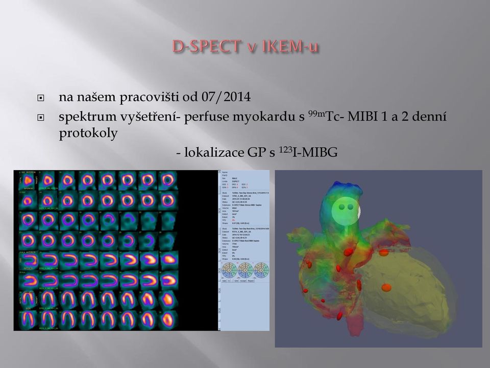 myokardu s 99m Tc- MIBI 1 a 2