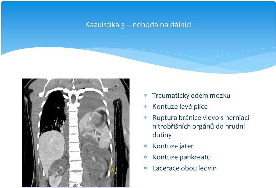 herniací nitrobřišních orgánů do hrudní dutiny