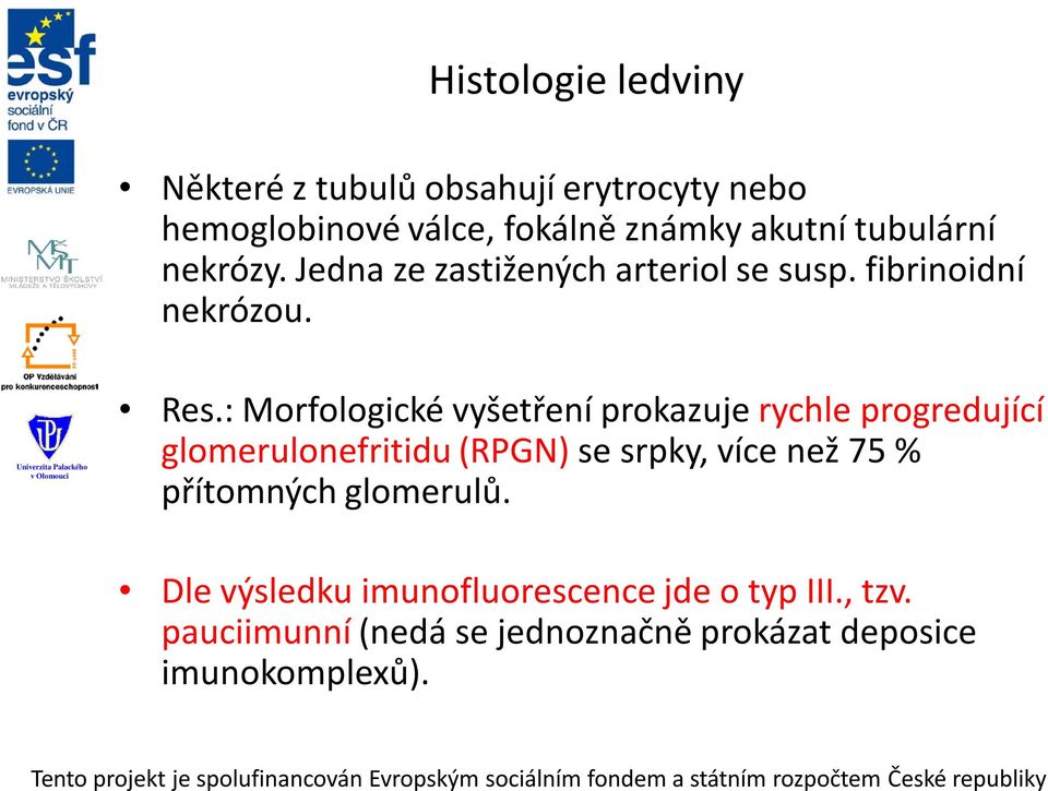 : Morfologické vyšetření prokazuje rychle progredující glomerulonefritidu (RPGN) se srpky, více než 75 %