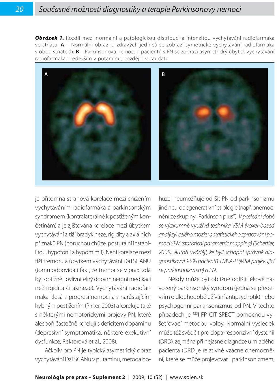 především v putaminu, později i v caudatu A B je přítomna stranová korelace mezi snížením vychytáváním radiofarmaka a parkinsonským syndromem (kontralaterálně k postiženým končetinám) a je zjišťována