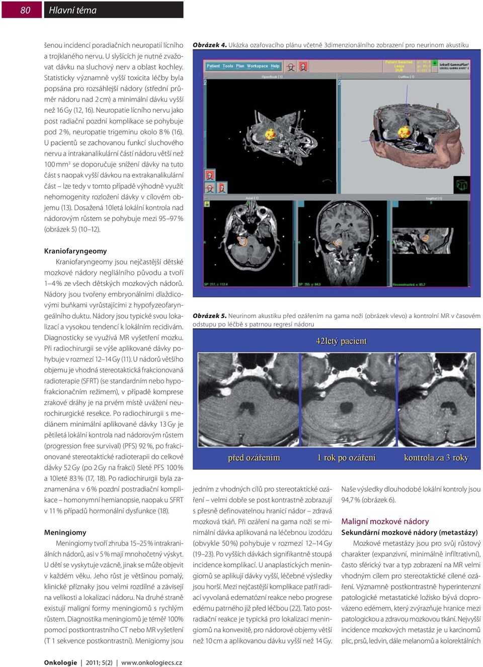 Neuropatie lícního nervu jako post radiační pozdní komplikace se pohybuje pod 2 %, neuropatie trigeminu okolo 8 % (16).