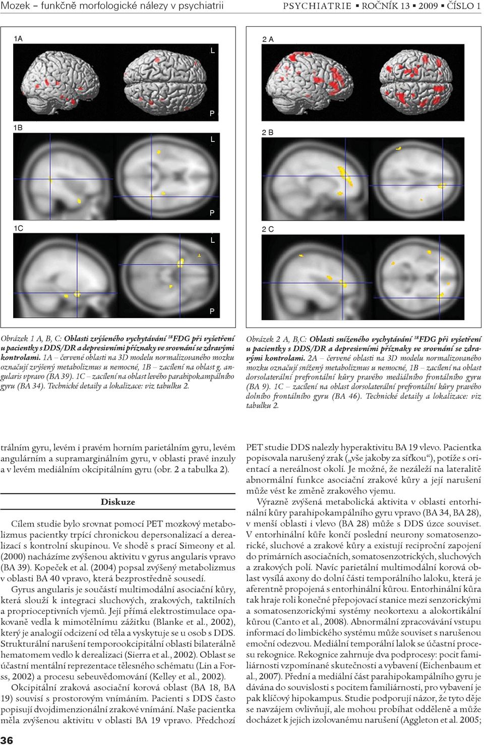 angularis vpravo (BA 39). 1C zacílení na oblast levého parahipokampálního gyru (BA 34). Technické detaily a lokalizace: viz tabulku 2.