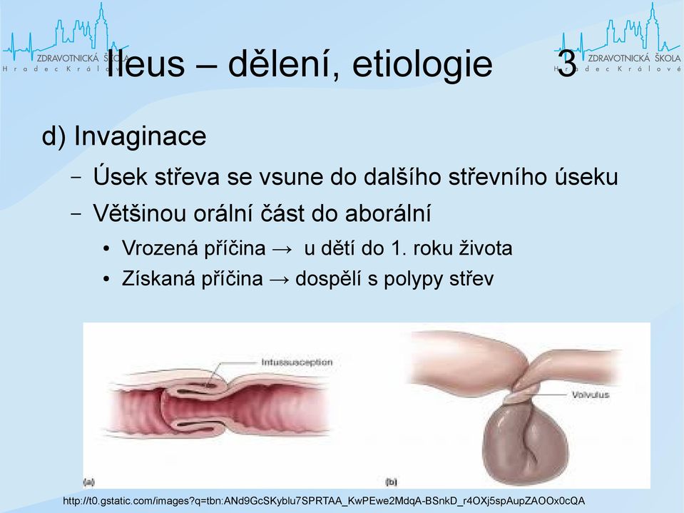 do 1. roku života Získaná příčina dospělí s polypy střev http://t0.