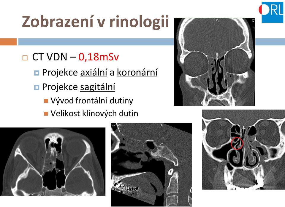 koronární Projekce sagitální