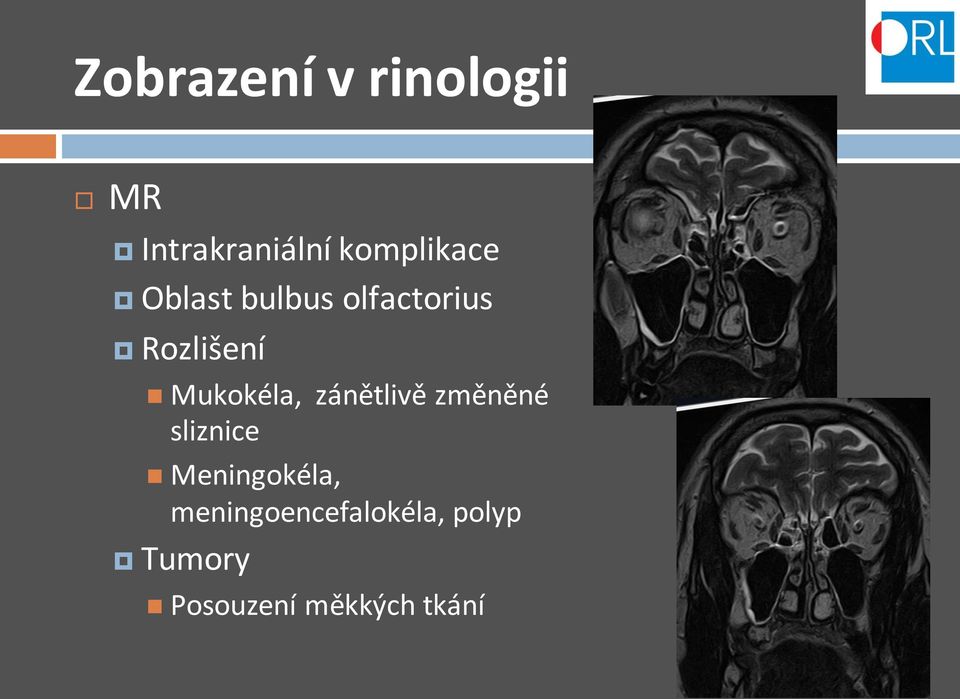 Mukokéla, zánětlivě změněné sliznice