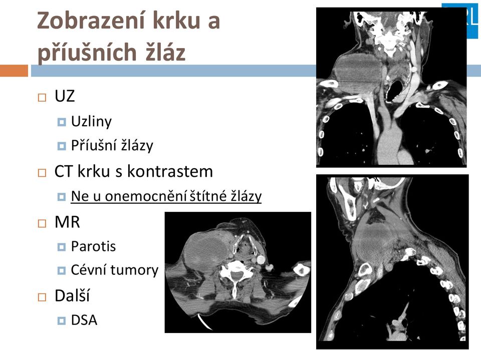 kontrastem Ne u onemocnění štítné