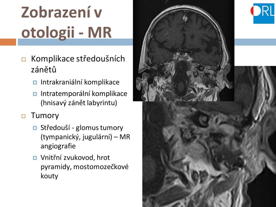 zánět labyrintu) Tumory Středouší - glomus tumory (tympanický,