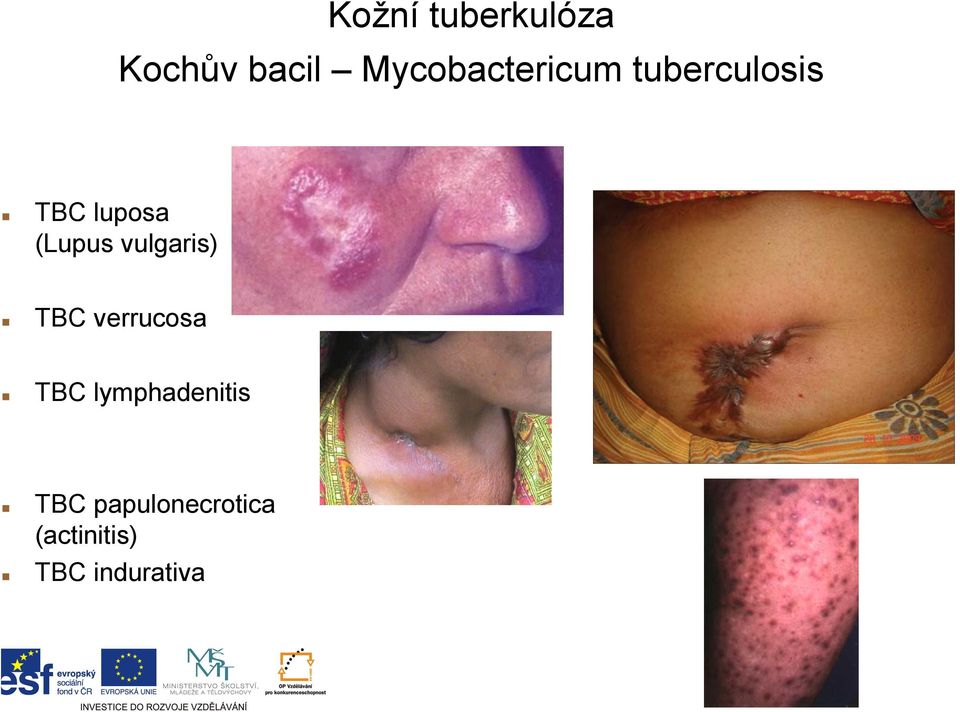 (Lupus vulgaris) TBC verrucosa TBC