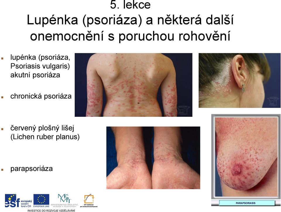 Psoriasis vulgaris) akutní psoriáza chronická