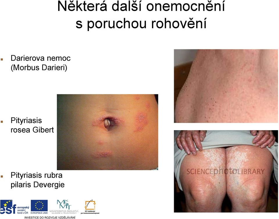 (Morbus Darieri) Pityriasis rosea