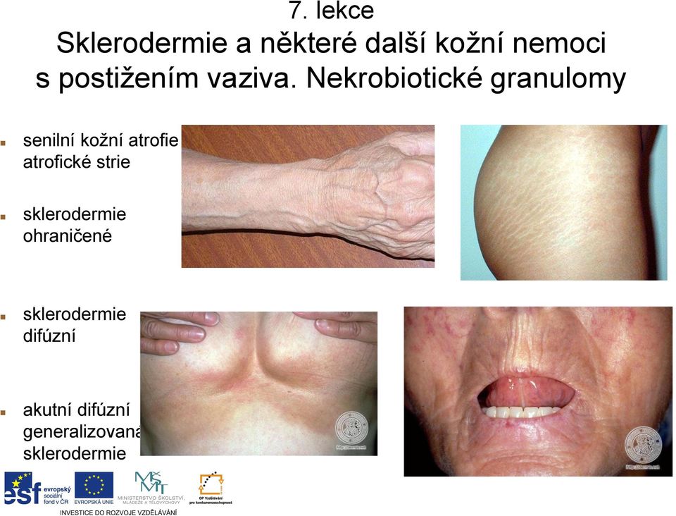 Nekrobiotické granulomy senilní kožní atrofie atrofické