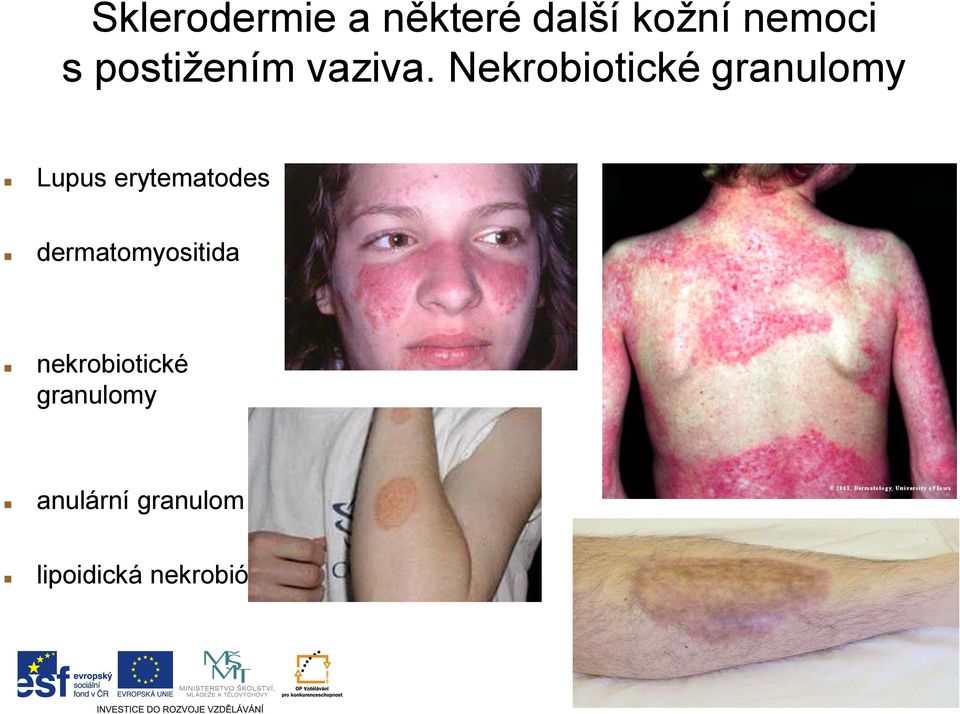 Nekrobiotické granulomy Lupus erytematodes