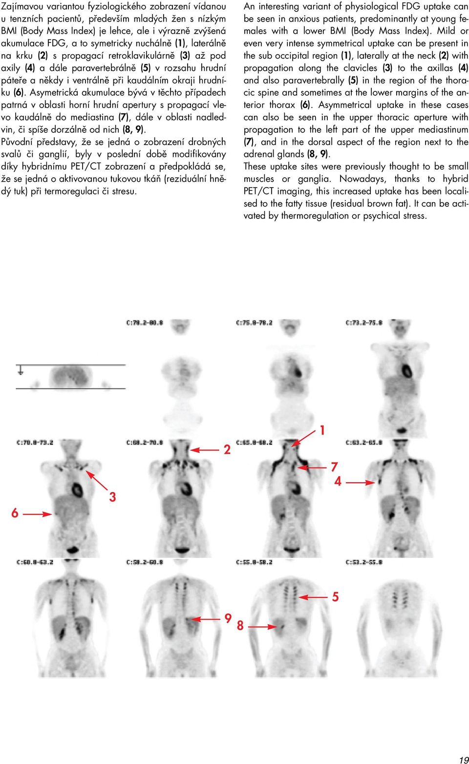 Asymetrická akumulace bývá v těchto případech patrná v oblasti horní hrudní apertury s propagací vlevo kaudálně do mediastina (7), dále v oblasti nadledvin, či spíše dorzálně od nich (8, 9).