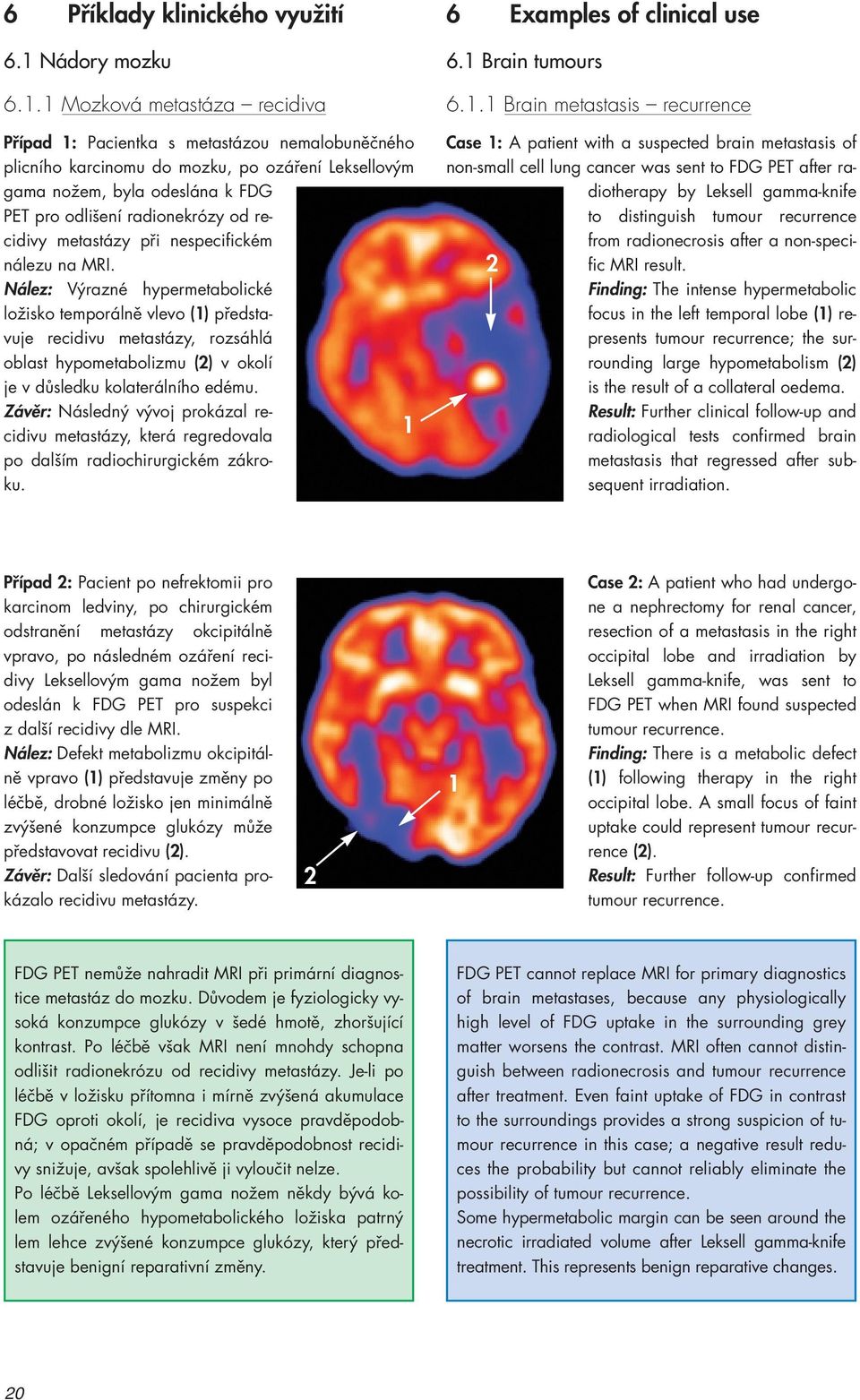 1 Mozková metastáza recidiva Pfiípad 1: Pacientka s metastázou nemalobuněčného plicního karcinomu do mozku, po ozáření Leksellovým gama nožem, byla odeslána k FDG PET pro odlišení radionekrózy od
