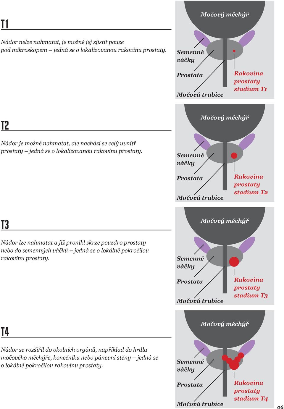 Semenné váčky Močový měchýř Prostata Močová trubice Rakovina prostaty stadium T2 T3 Nádor lze nahmatat a již pronikl skrze pouzdro prostaty nebo do semenných váčků jedná se o lokálně pokročilou