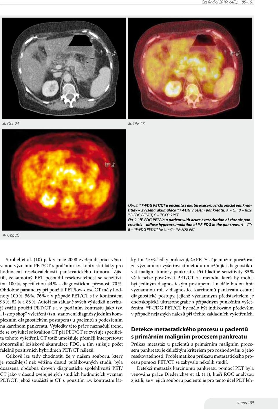 A CT; B F-FDG PET/CT fusion; C F-FDG PET Strobel et al. (10) pak v roce 2008 zveřejnili práci věnovanou významu PET/CT s podáním i.v. kontrastní látky pro hodnocení resekovatelnosti pankreatického tumoru.