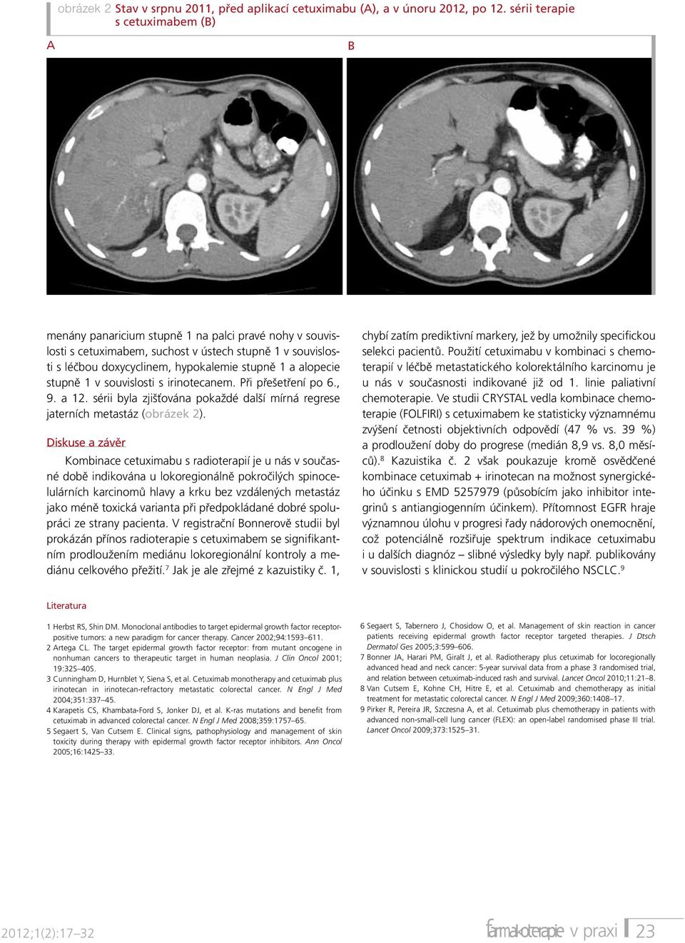 alopecie stupně 1 v souvislosti s irinotecanem. Při přešetření po 6., 9. a 12. sérii byla zjišťována pokaždé další mírná regrese jaterních metastáz (obrázek 2).
