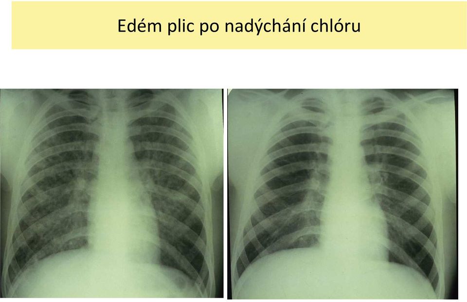 nadýchání