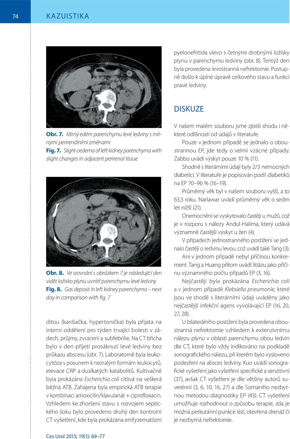 8. Ve srovnání s obrázkem 7 je následující den vidět ložisko plynu uvnitř parenchymu levé ledviny Fig. 8. Gas deposit in left kidney parenchyma next day in comparison with fig.