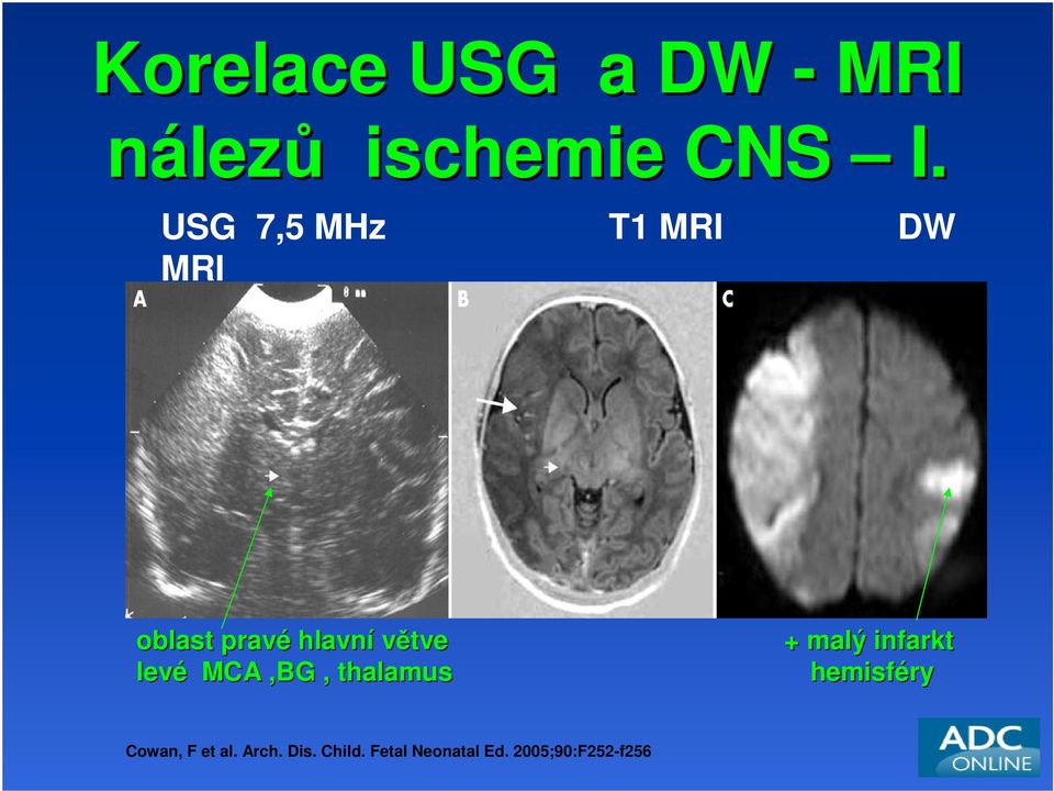 malý infarkt levé MCA,BG, thalamus hemisféry Cowan, F