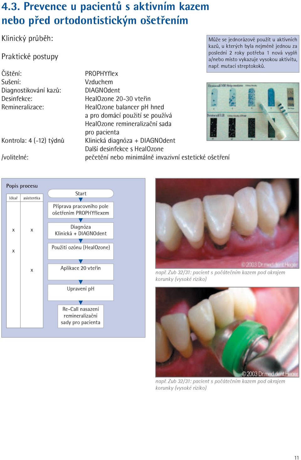 DIAGNOdent Další desinfekce s HealOzone pečetění nebo minimálně invazivní estetické ošetření Může se jednorázově použít u aktivních kazů, u kterých byla nejméně jednou za poslední 2 roky potřeba 1